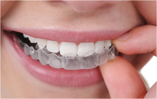 INVISALIGN