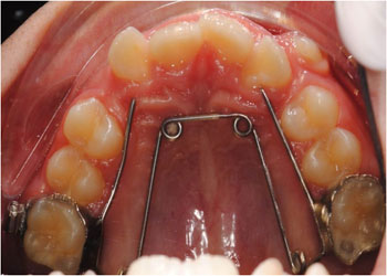 Quad helix